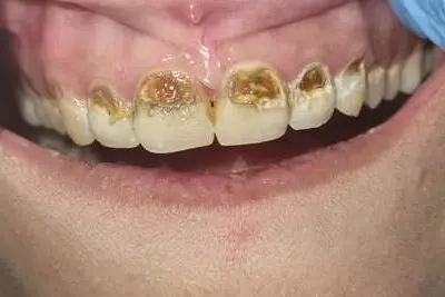The patient's teeth before treatment