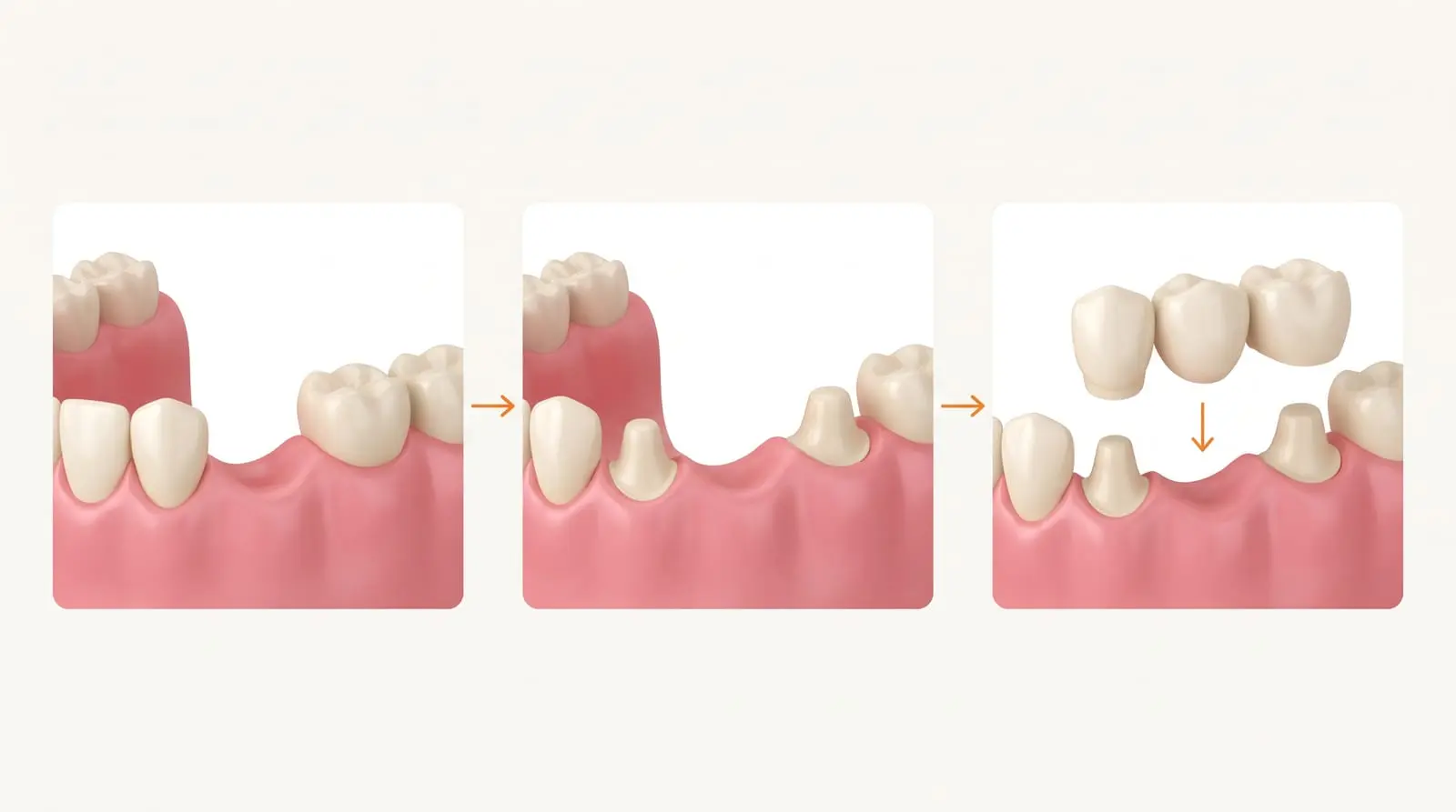 Illustration in three steps: a gap from a missing tooth, the neighbouring teeth shaped, then a three-part bridge lowered over them