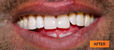 After: Composite restoration case 1