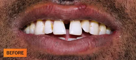 Before: Composite restoration case 1
