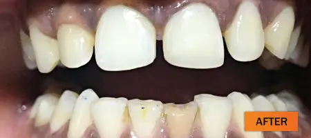 After: Composite restoration case 2
