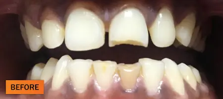 Before: Composite restoration case 2