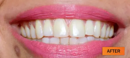 After: Composite restoration case 3