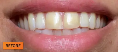 Before: Composite restoration case 3
