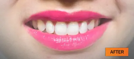 After: Composite restoration case 4