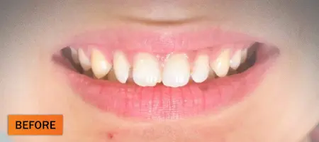 Before: Composite restoration case 4