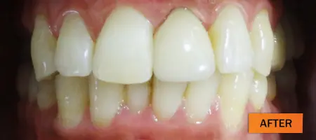 After: Dental implant case 1