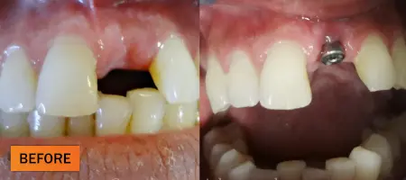 Before: Dental implant case 1