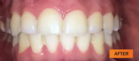 After: Dental implant case 2