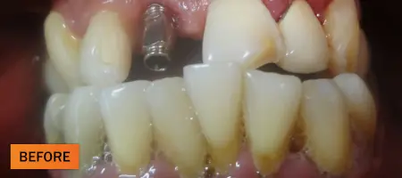 Before: Dental implant case 2