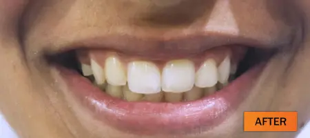 After: Dental implant case 3