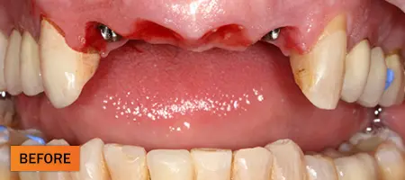 Before: Dental implant case 3