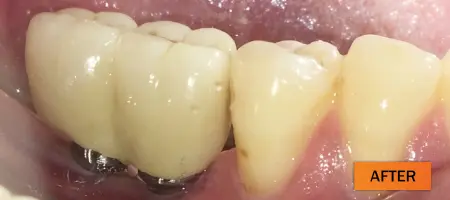 After: Dental implant case 4