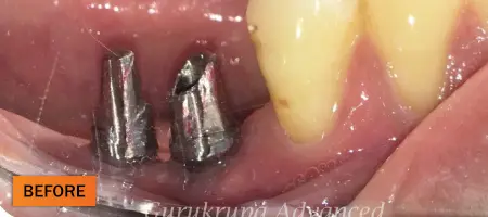 Before: Dental implant case 4