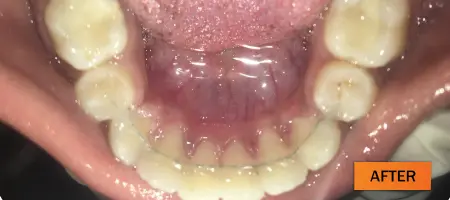 After: Orthodontic braces case 2