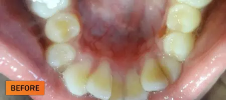 Before: Orthodontic braces case 2