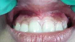 After: Frenectomy - labial frenum removal