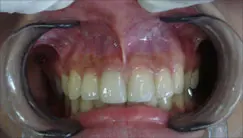 Before: Frenectomy - labial frenum removal