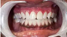 After: Gum depigmentation - melanin removal