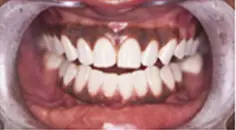 Before: Gum depigmentation - melanin removal