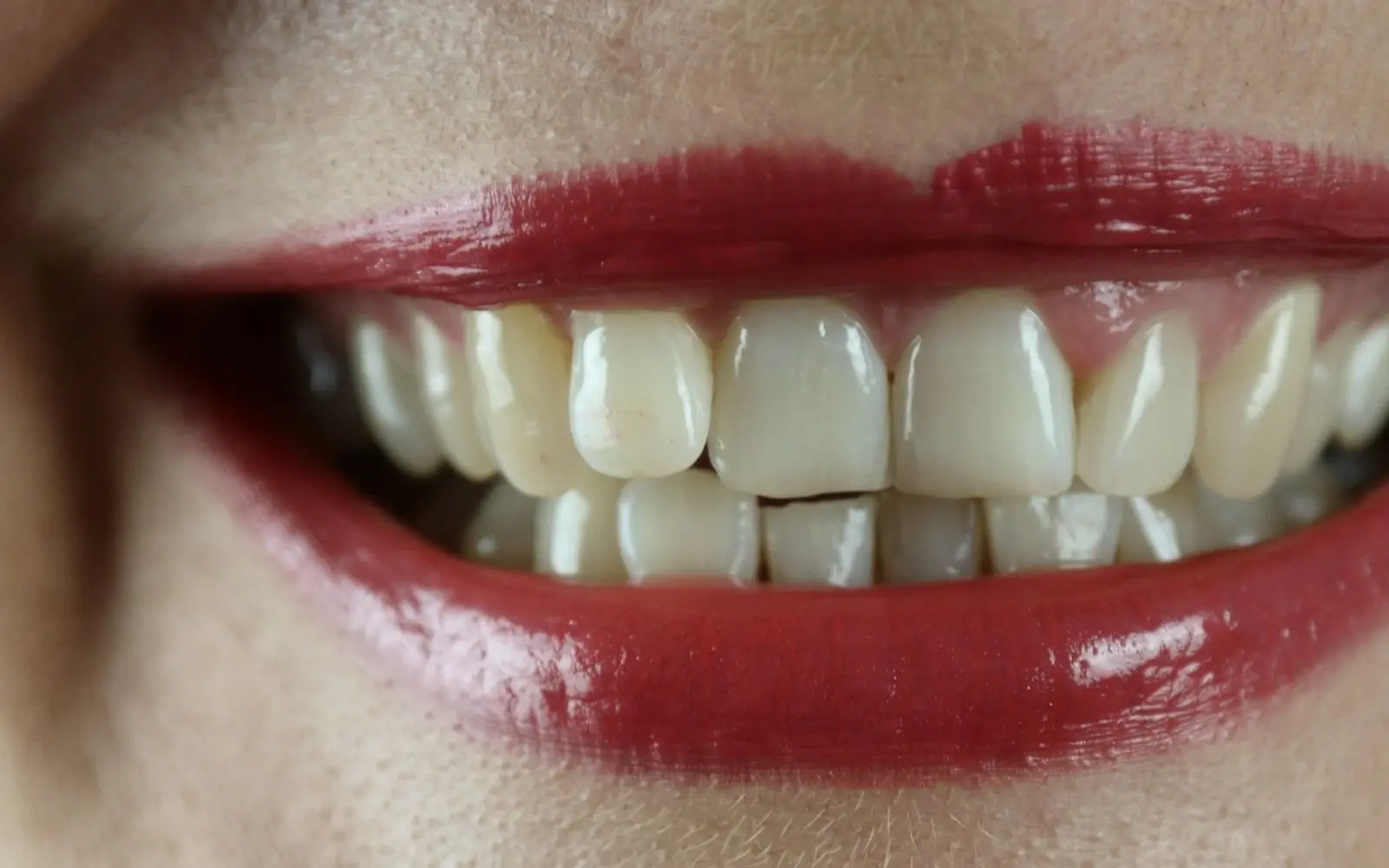 Close-up of a smile with chipped and uneven front teeth