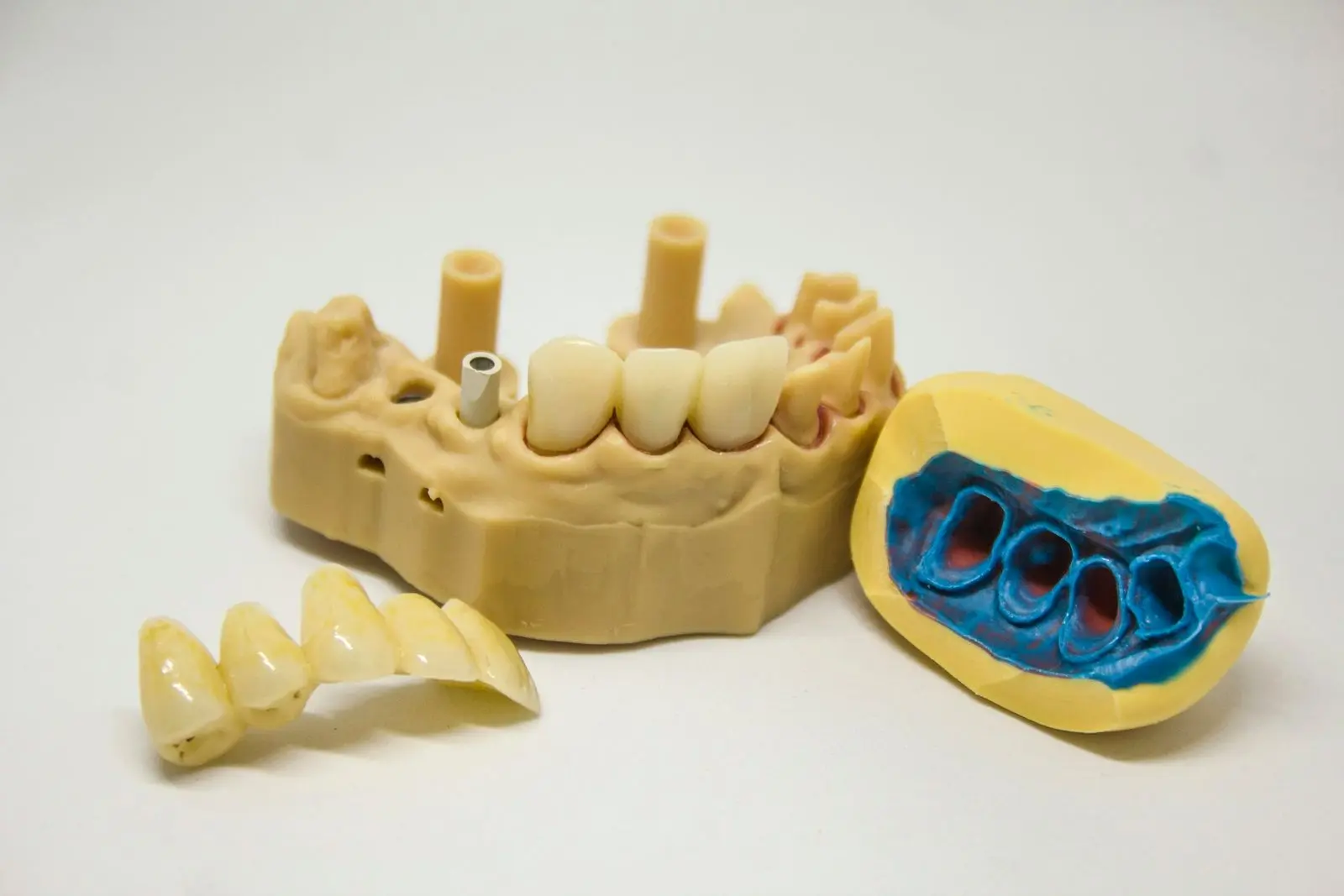 Dental bridge with several joined teeth beside a plaster model and impression