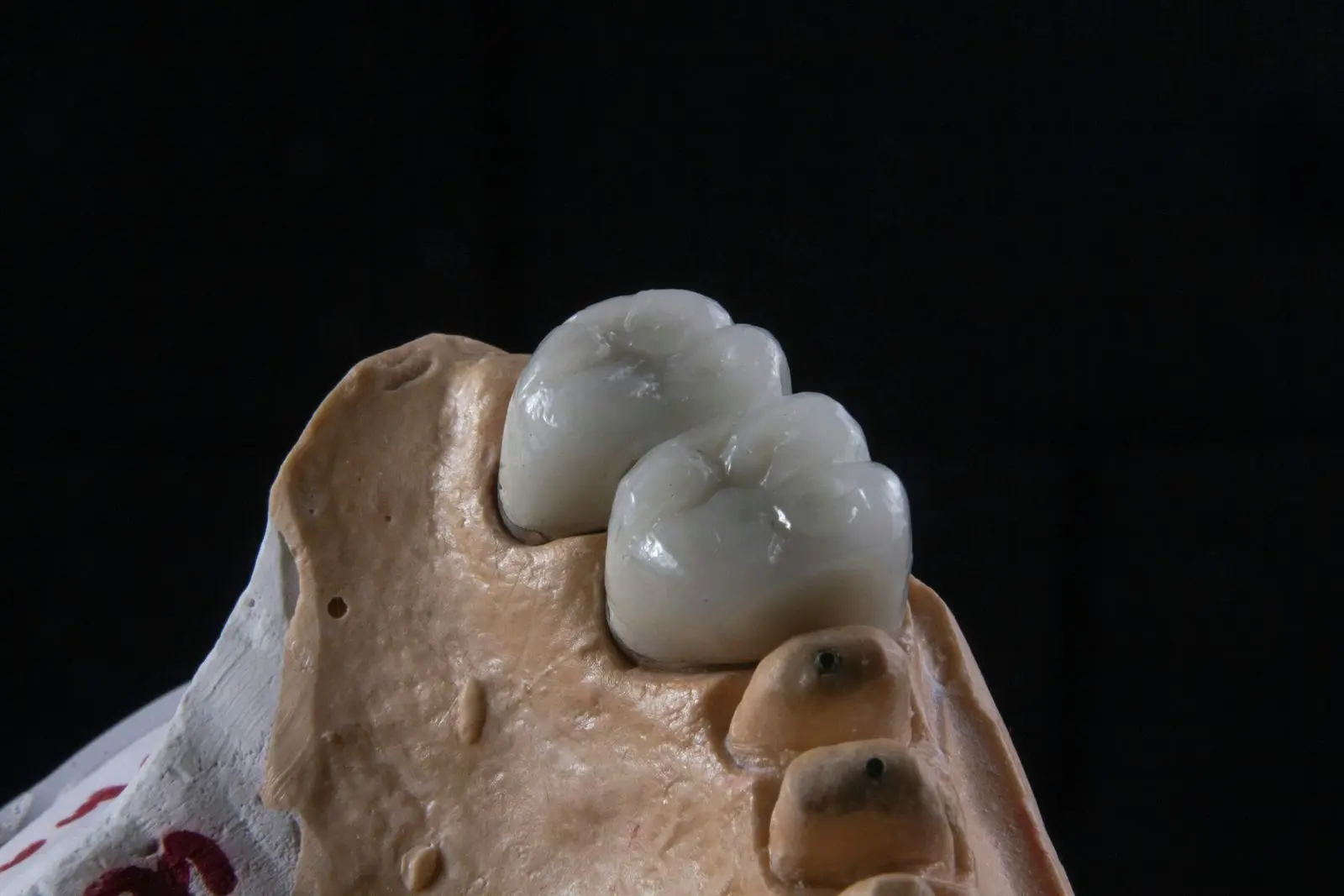 Two ceramic molar crowns seated on a dental model against a black background