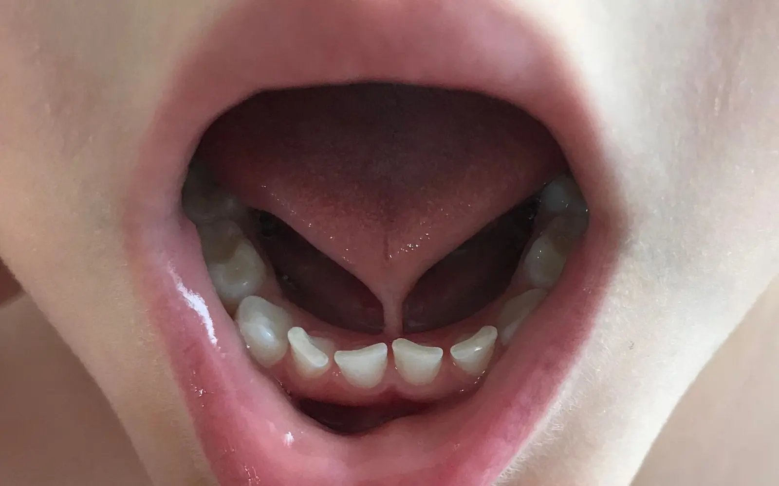 Child with the tongue lifted, showing a short tight band under the tongue that pulls the tip into a heart shape
