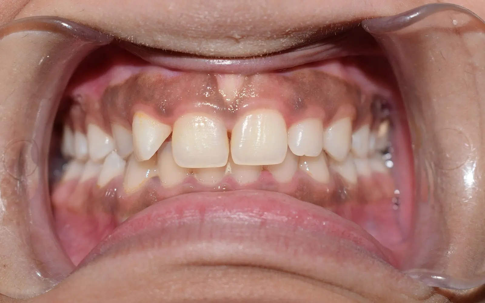 Front view of a smile with dark brownish gums above the upper front teeth