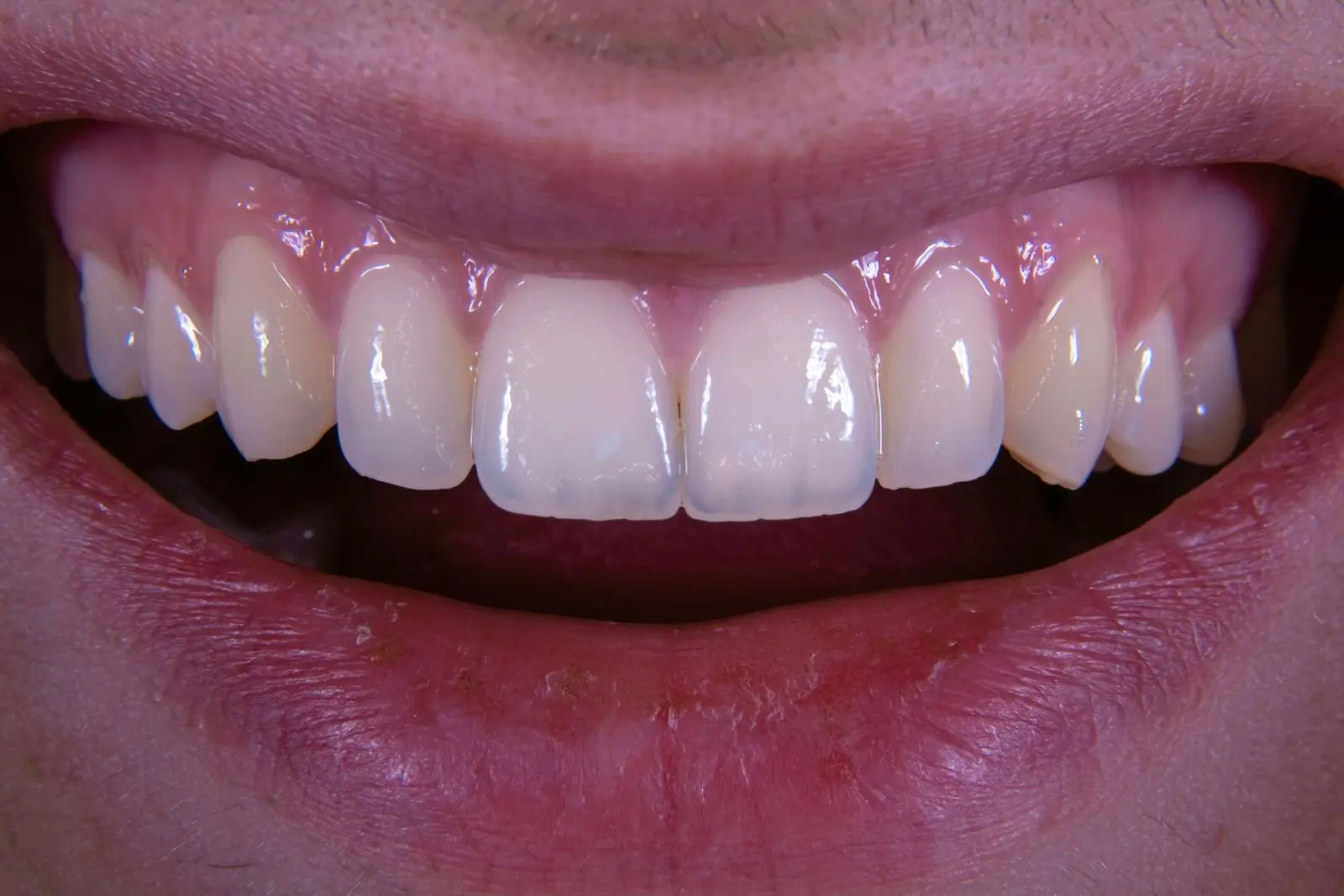 Close-up of a wide smile showing the upper gum line above the front teeth