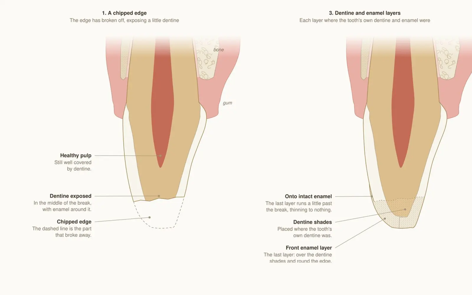 Cross-section drawings of a front tooth with a chipped edge on the left and the same edge rebuilt with bonding on the right