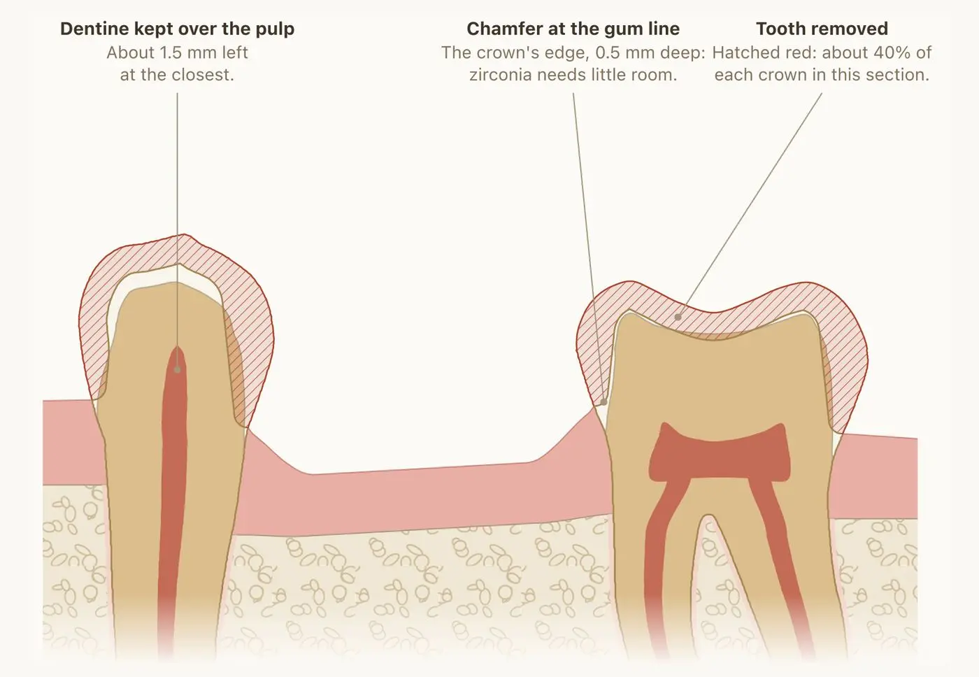 Cross-section of the two teeth on either side of a gap, each cut down for a crown, with the removed tooth shown as red hatching