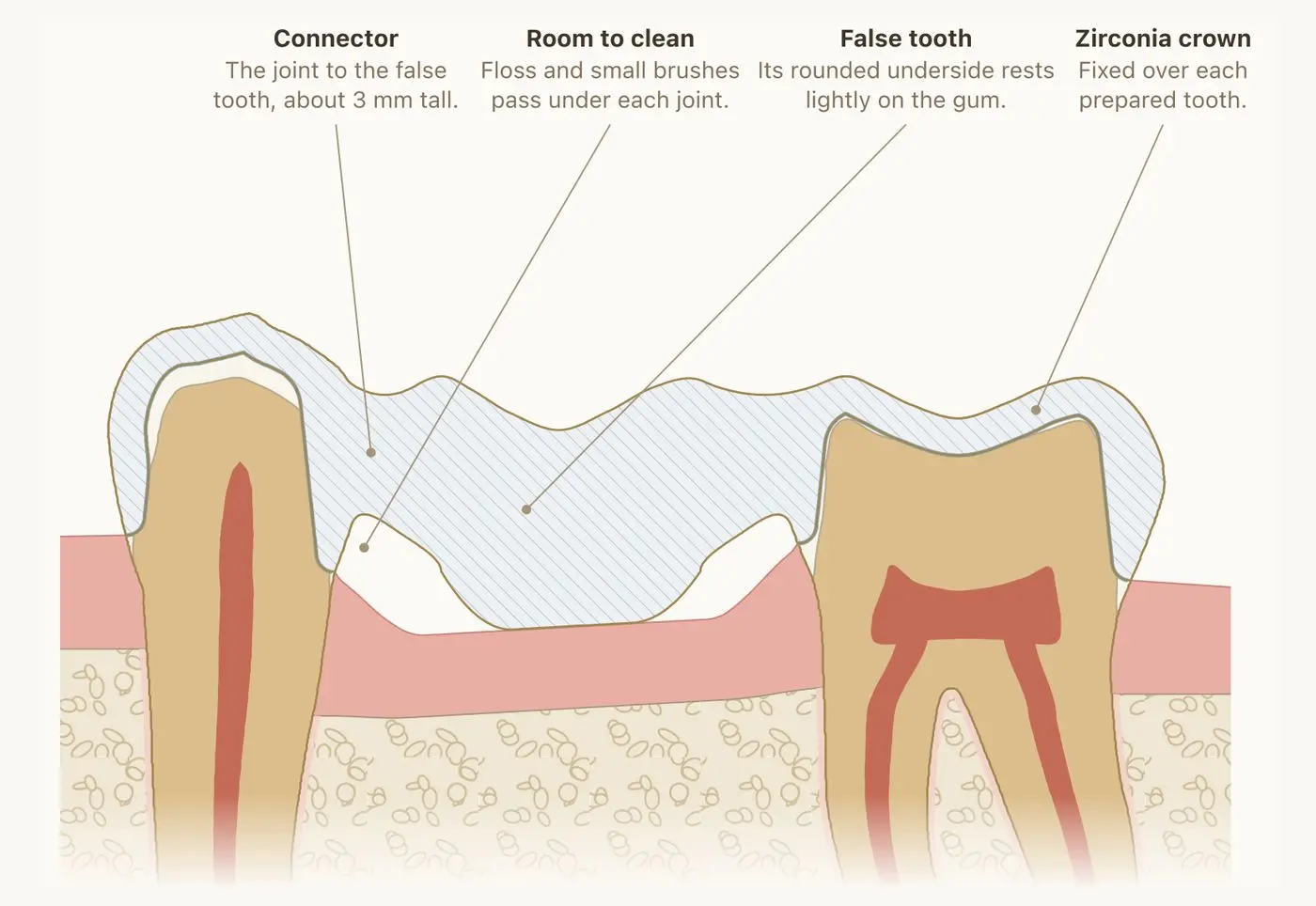 Cross-section of a finished three-part bridge, a crown on each neighbouring tooth joined to a false tooth that rests lightly on the gum