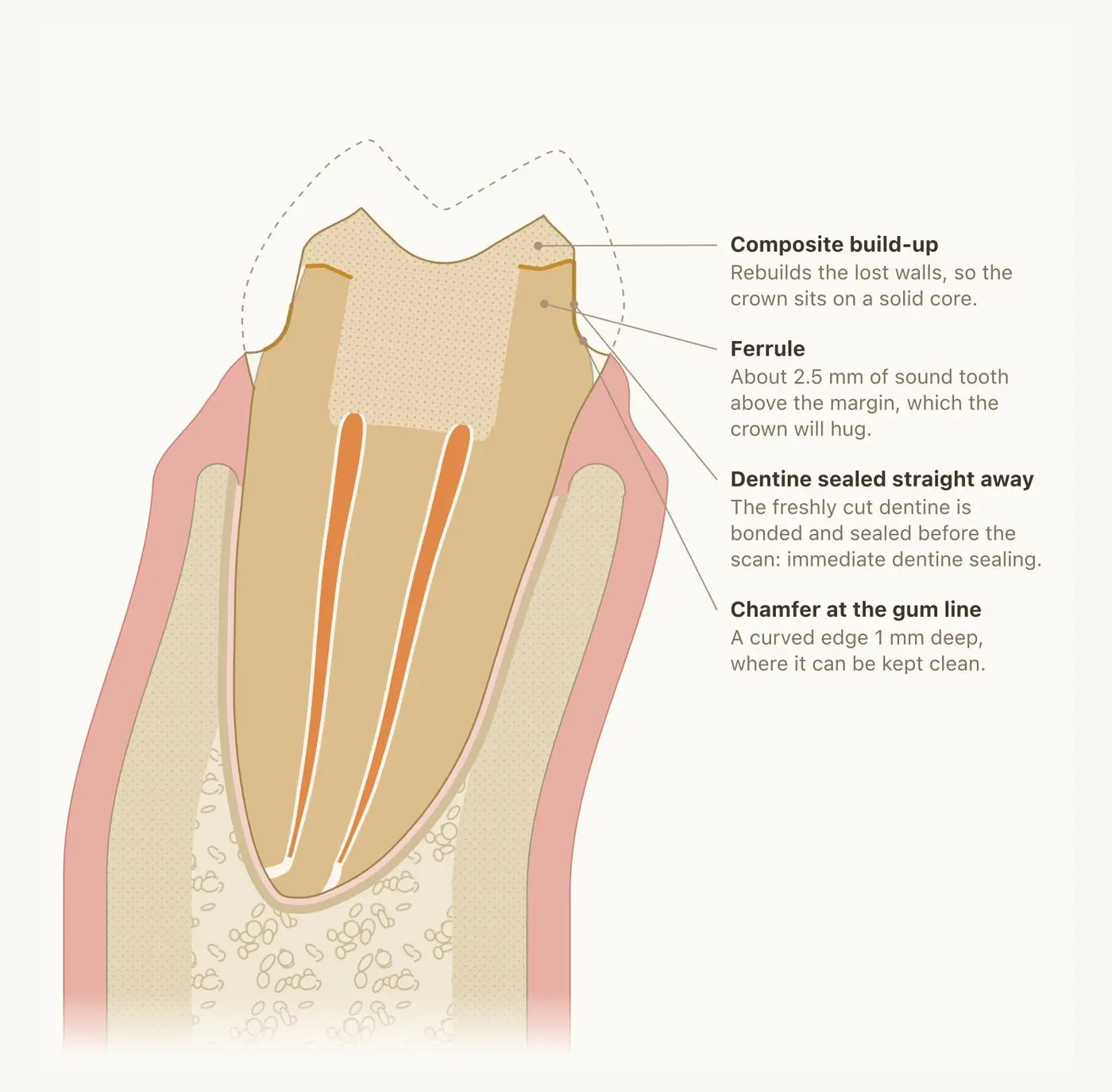 Cross-section of a root-filled molar with a rebuilt core and a curved edge cut at the gum line, ready for a crown