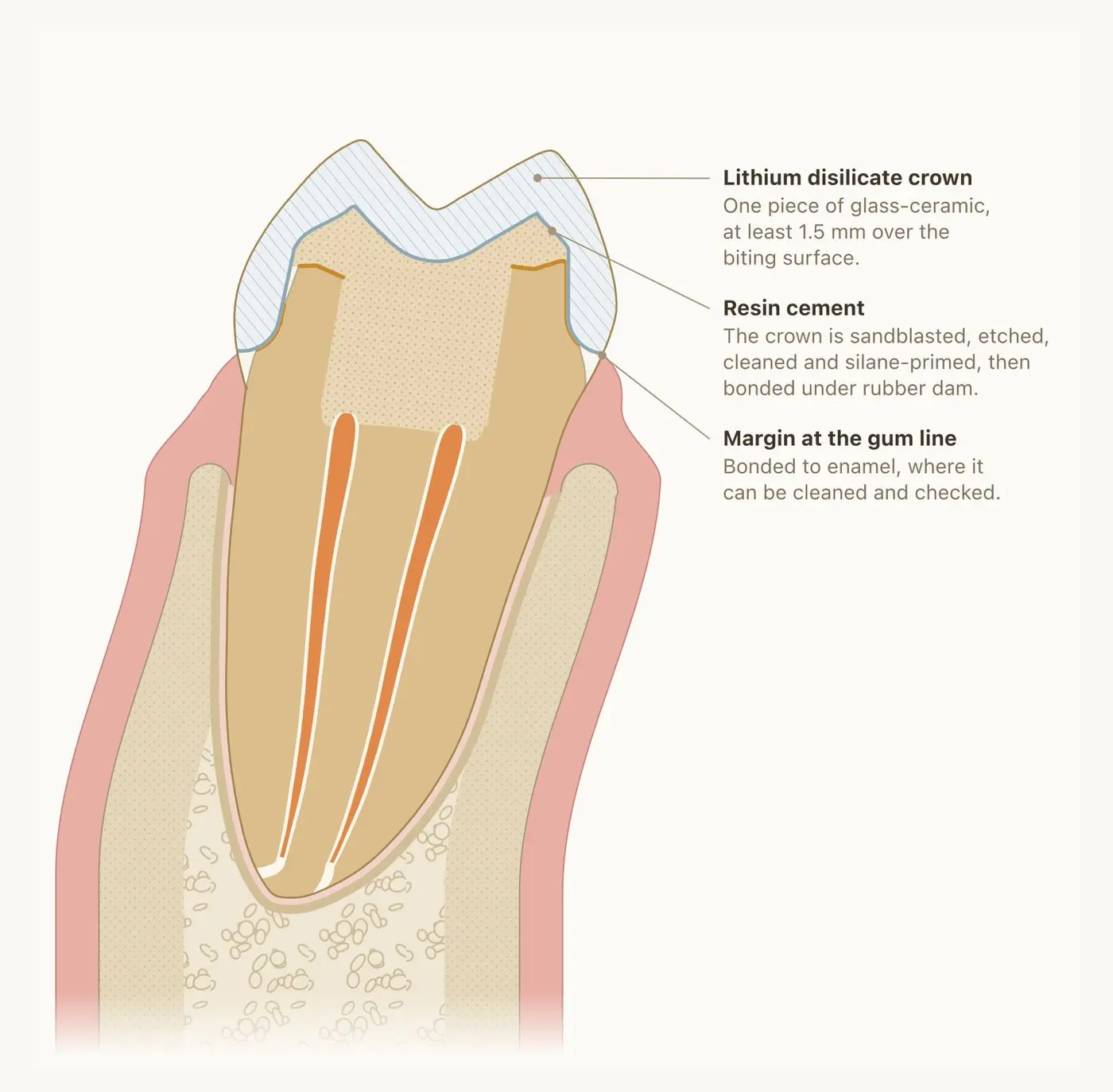 Cross-section of a molar with a ceramic crown bonded over the rebuilt core, its edge at the gum line