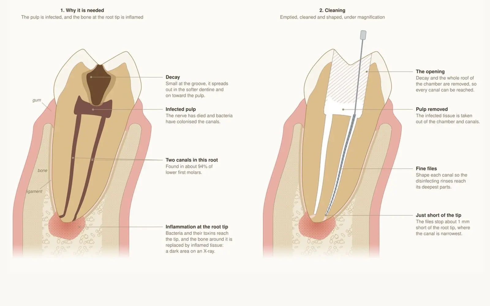Cross-section drawing of a molar with deep decay, an infected nerve and inflamed bone at the root tip, next to the cleaned canal
