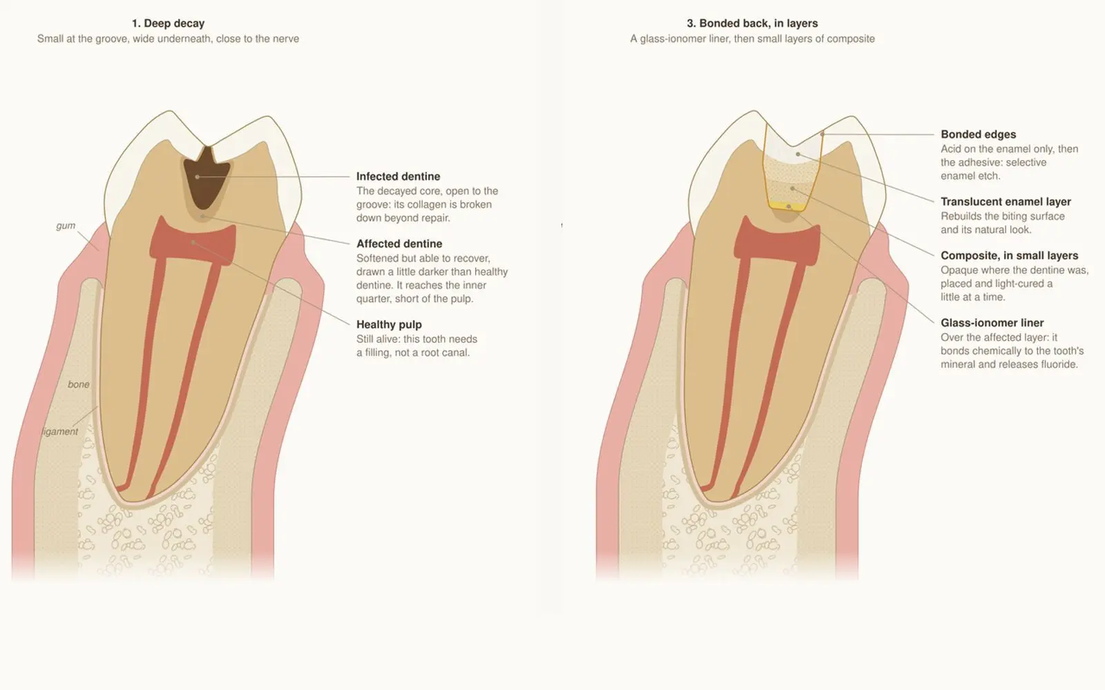 Cross-section drawings of a molar with a decayed groove on the left and the same tooth with a tooth-coloured filling on the right