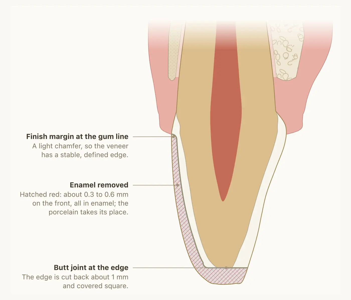 Cross-section of a front tooth with a hatched red strip of enamel along the front and at the biting edge showing what is removed for a veneer
