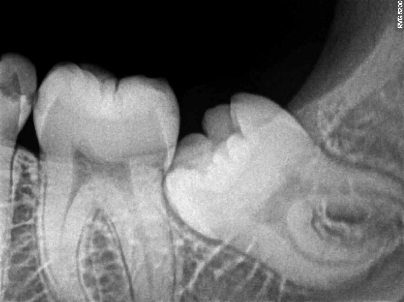 Dental X-ray of a lower wisdom tooth lying tilted against the second molar in front of it