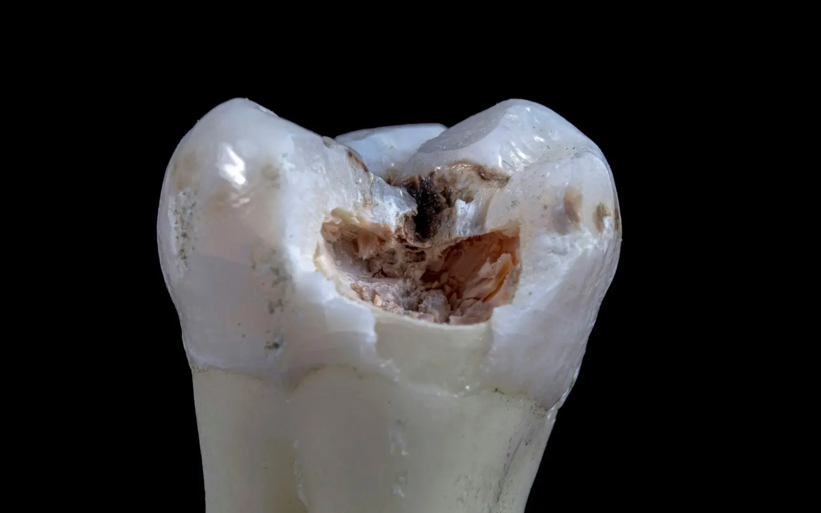 Extracted molar with a dark cavity eaten into the biting surface, on a black background