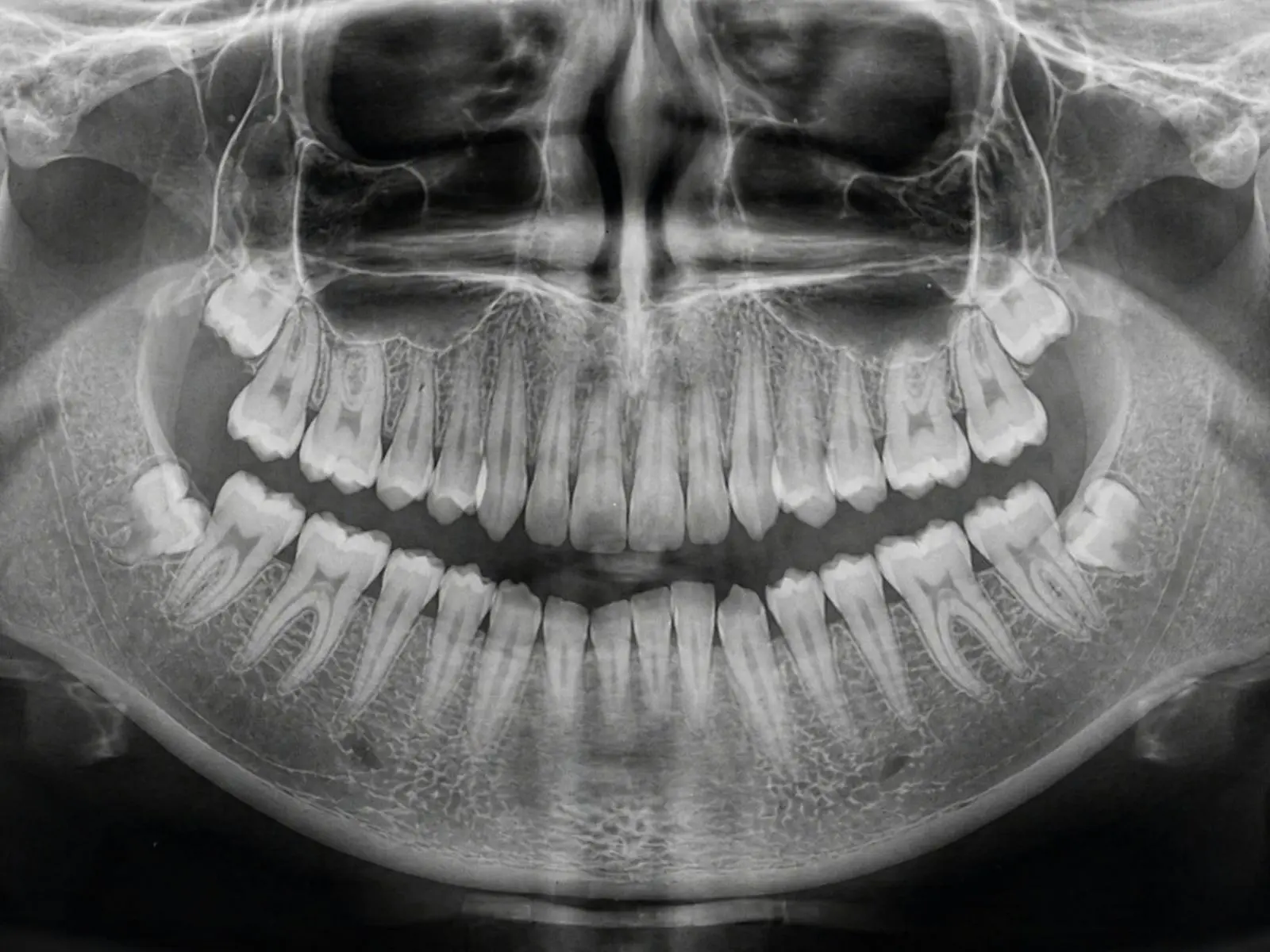 Panoramic dental X-ray showing all teeth including the wisdom teeth