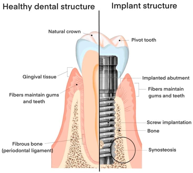 Cross-section comparing a natural tooth on the left with an endosteal implant on the right, both shown seated in the jawbone with the gum line and bone labelled.