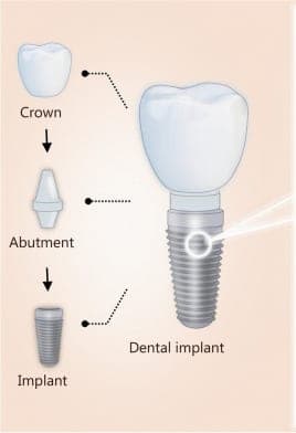 Diagram of the three parts of a dental implant: the crown on top, the abutment connector in the middle, and the threaded titanium implant that sits in the jawbone.