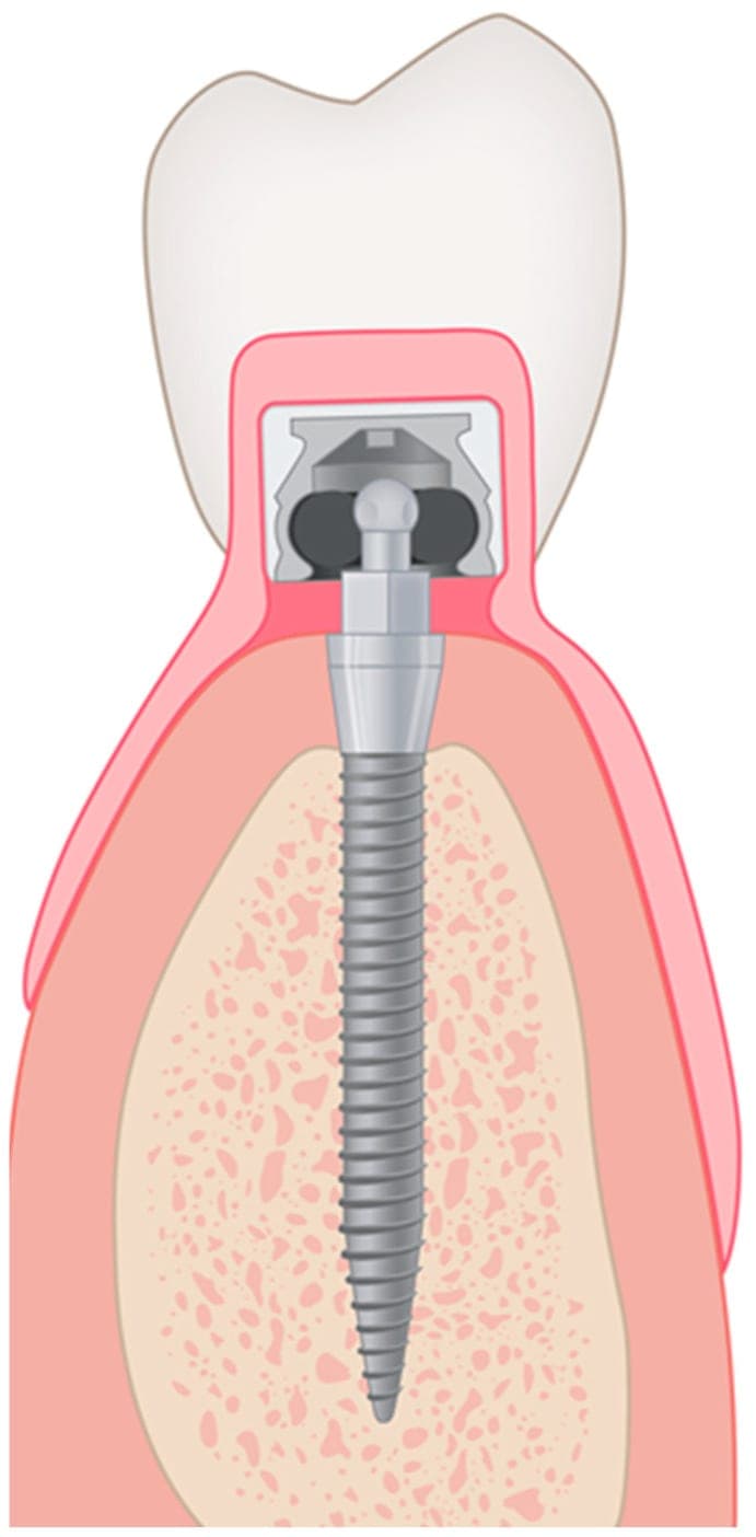 Cutaway of a narrow mini implant in the jawbone, its rounded head clipping into a retention housing set inside an overdenture.