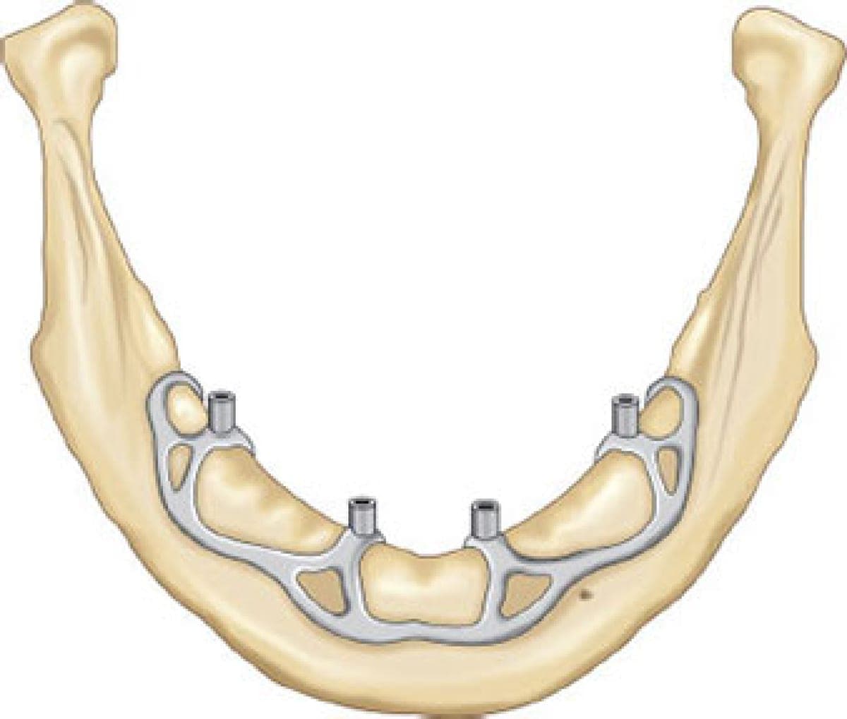 A custom metal framework resting on top of the lower jawbone, with four small posts projecting upward to hold a denture.