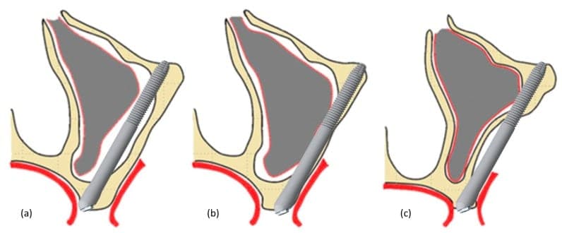 Three cross-sections of the upper jaw showing the different paths a long zygomatic implant can take up into the cheekbone, passing beside the sinus.