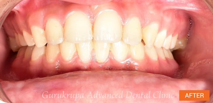 After orthodontic treatment: upper and lower teeth aligned into an even arch.