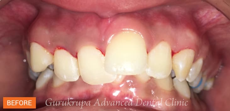 A patient's upper teeth before orthodontic treatment, crowded and with one front tooth sitting forward of the others.