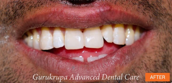 After treatment: the same front teeth restored to an even shape and shade with veneers.