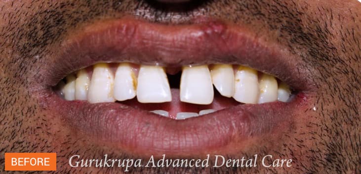 Before treatment: front teeth with visible chips, uneven edges and a gap, photographed at the clinic.